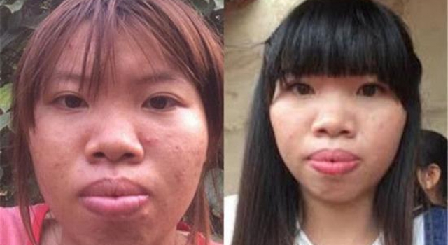 越南女子花十万整容闪婚嫁给富二代 之前真的太丑了!