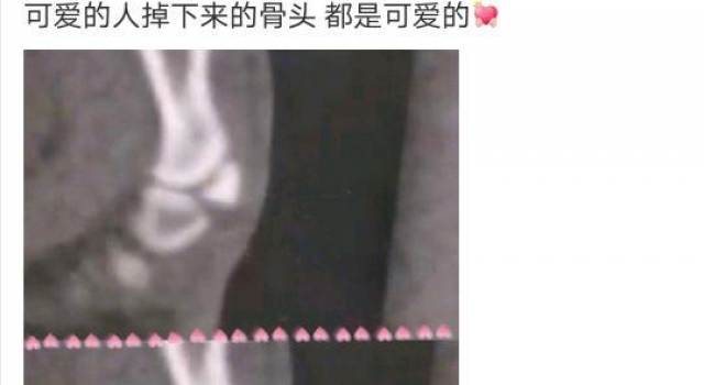 张嘉倪发文自曝受伤,骨头掉下来了,配文:连骨头都是可爱的呢