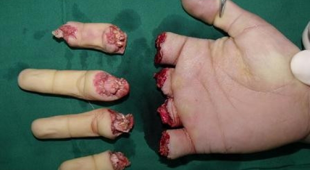 女工10根手指被电锯锯断 及时手术21小时全部接活