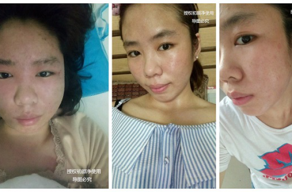 治愈激素脸最好的方法,激素脸如此治疗才最彻底