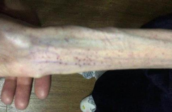 21岁女生减肥厌食至25公斤　手术后醒来即要吃东西
