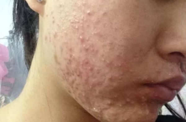 激素脸满脸疹子怎么办？激素脸排毒排出小疙瘩