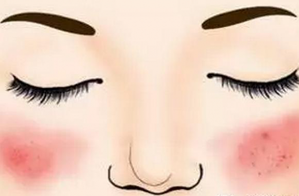 激素脸为什么泛红不退？激素脸角质层受损严重能修复好吗