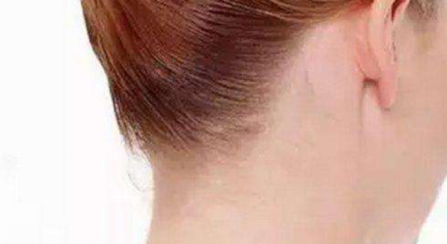 脖子黑是什么原因？脖子黑线怎么去掉