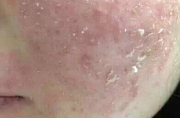 激素脸用什么方法补水?激素脸干燥紧绷脱皮怎么办