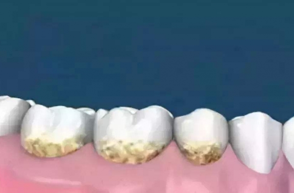 处理牙结石的五个土办法 省钱还省力