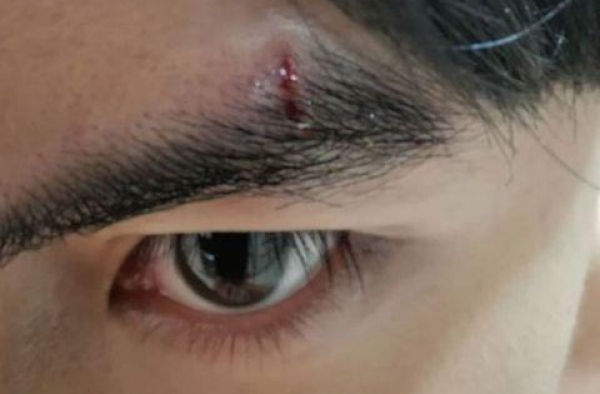 36岁男星被灯柱砸脸眉骨血流如注，曾连续40度高烧险休克致死