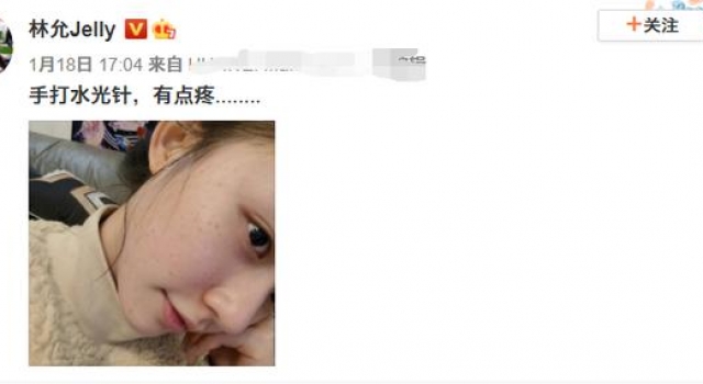 星女郎林允白嫩左脸满是针眼，密密麻麻好吓人，为了变美也太拼了