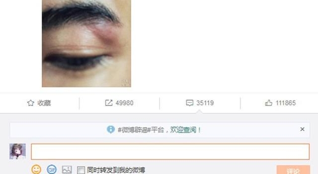 于朦胧拍戏左眼又受伤怎么回事？于朦胧左眼受伤严重吗？